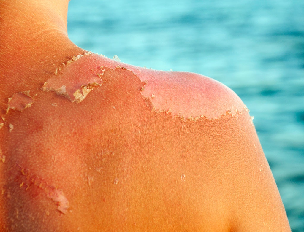 Burnout für die Haut – Was tun bei Sonnenbrand?